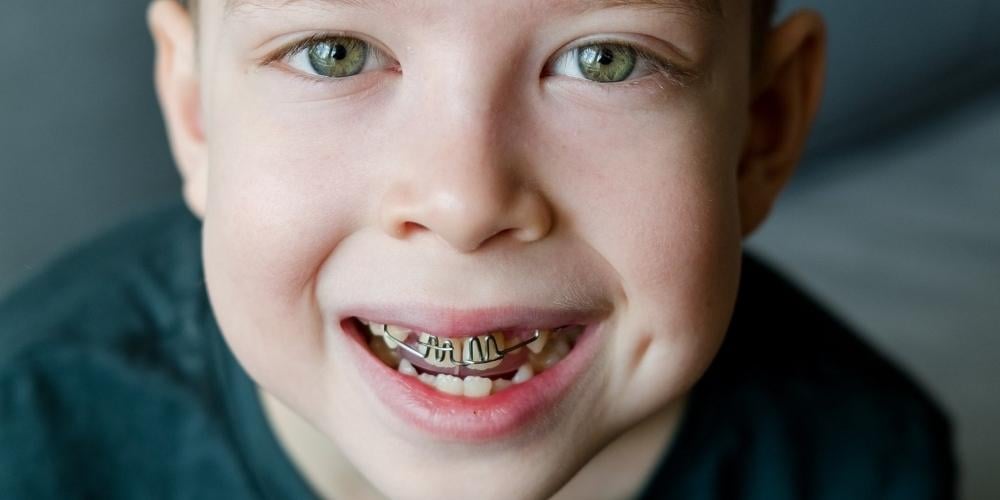 brackets-nino-ortodoncia-infantil-dentista